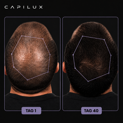Rotlichttherapie-Mütze